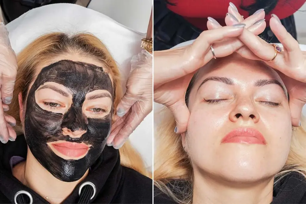 Tratamentul Laser Carbon Peel este o abordare revoluţionară cu beneficii imediate de întinerire, curăţare, exfoliere şi hidratare a tenului.