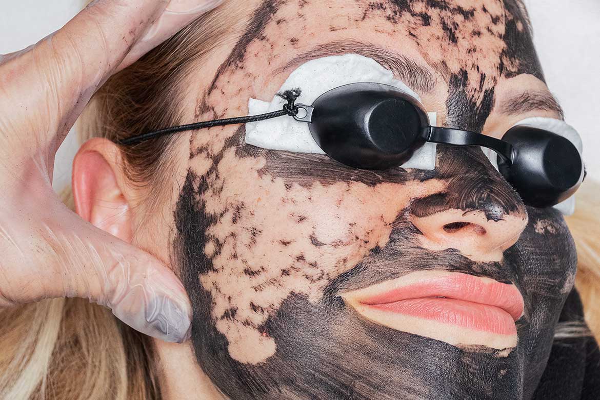 Tratamentul Laser Carbon Peel diminuează porii, elimină celule moarte, oferind un ten radiant, vizibil îmbunătăţit şi fin la atingere!