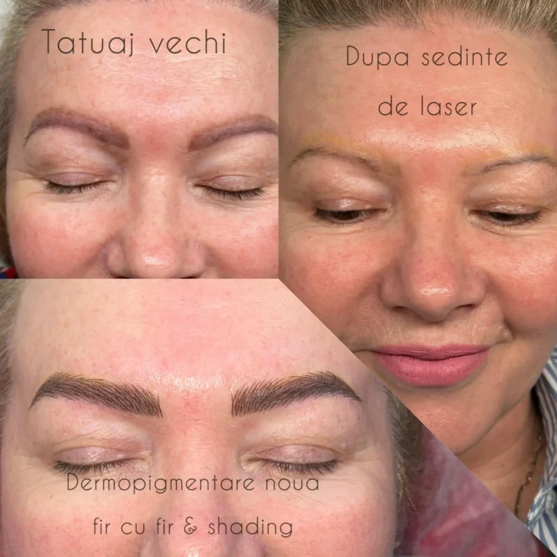 Rezultate-sedinte-laser-01