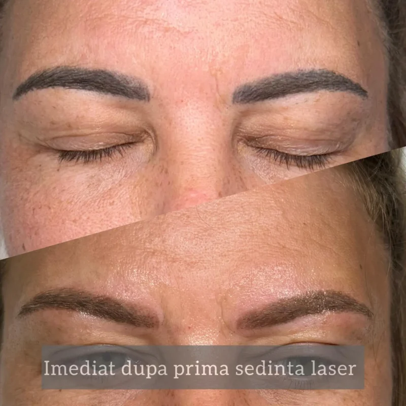Rezultate-sedinte-laser-02