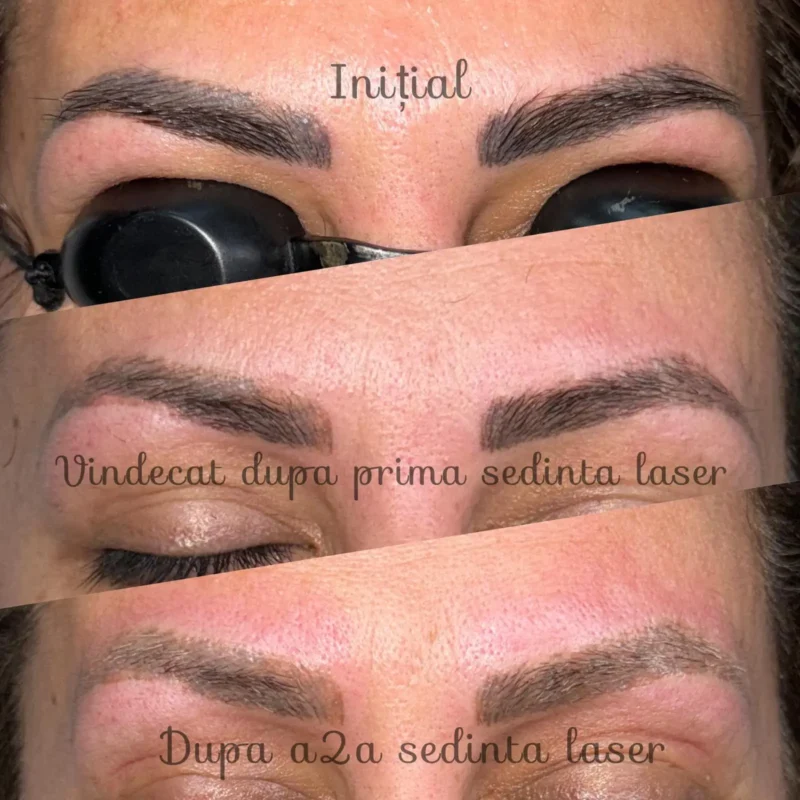 Rezultate-sedinte-laser-03