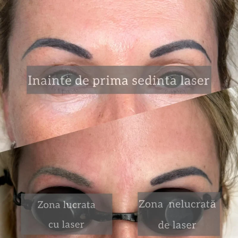 Rezultate-sedinte-laser-04