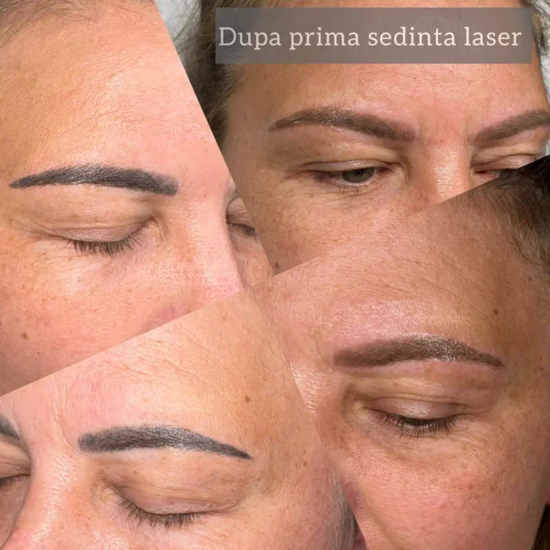 Rezultate-sedinte-laser-05
