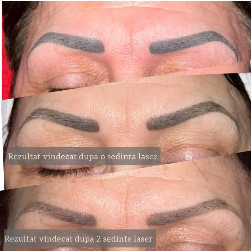 Rezultate-sedinte-laser-06