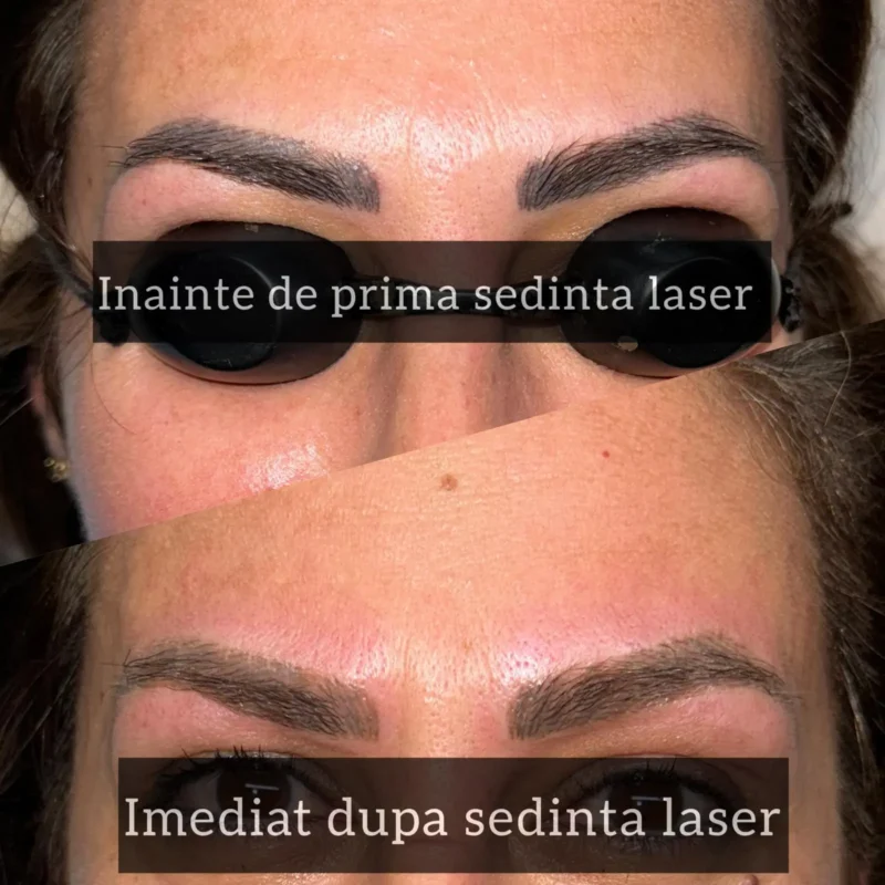 Rezultate-sedinte-laser-07