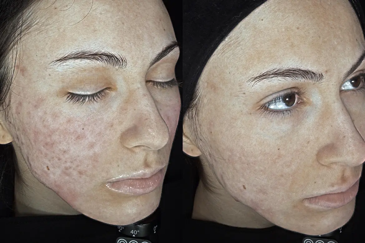 Combaterea acneei vulgare la Visage Clinique s-a desfăşurat pe mai multe etape, reuşind în final să-i oferim tinerei reducerea cu peste 90% a leziunilor acneice active.